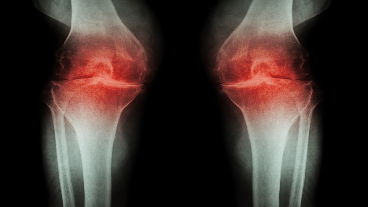 knee-osteoarthritis