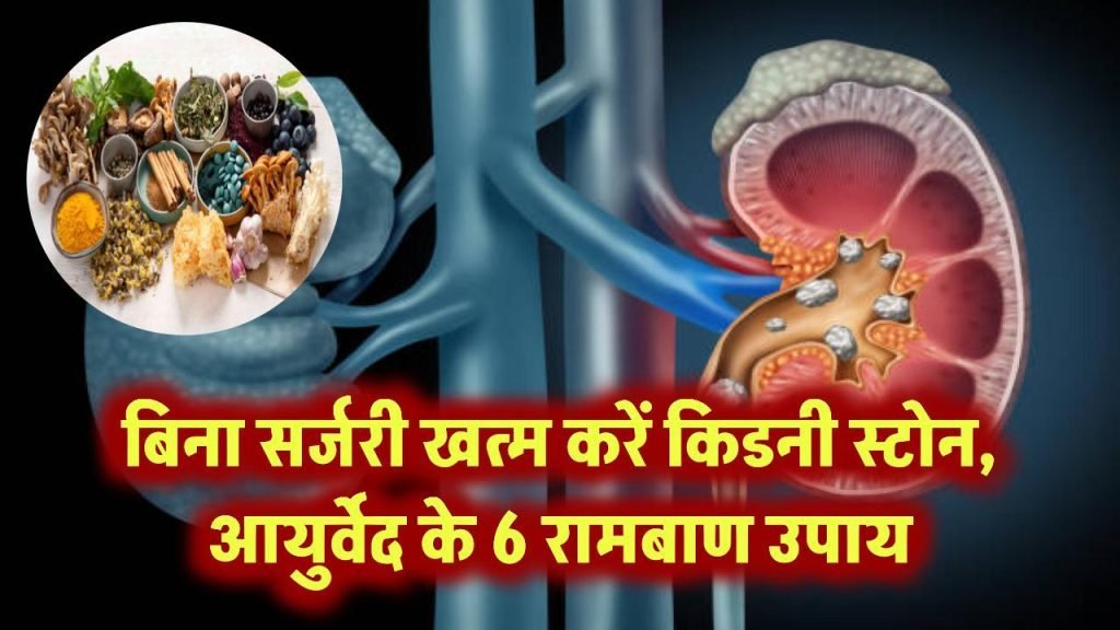 6-best-ayurvedic-home-remedies-to-dissolve-kidney-stones-naturally-1024×576
