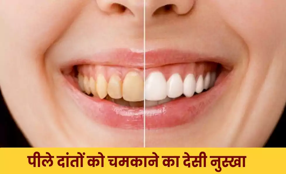 ना डॉक्टर ना खर्चा… बस ये देसी पेस्ट बना लें और देखें कैसे पीले दांतों की जगह दिखेगी सफेद चमक ना डॉक्टर ना खर्चा… बस ये देसी पेस्ट बना लें और देखें कैसे पीले दांतों की जगह दिखेगी सफेद चमक